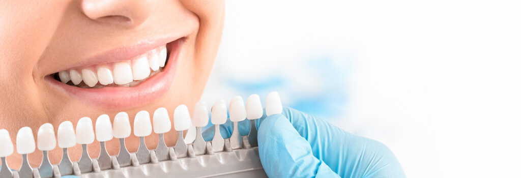Nubeam: Where Affordability Meets Professional Teeth Whitening