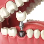 Understanding Dental Implants: A Journey to Restored Smiles