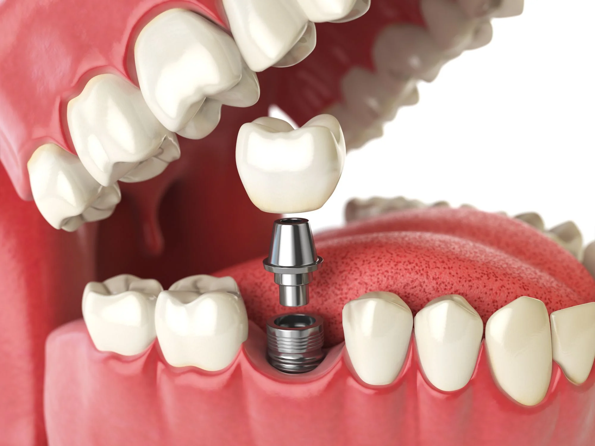 Understanding Dental Implants: A Journey to Restored Smiles